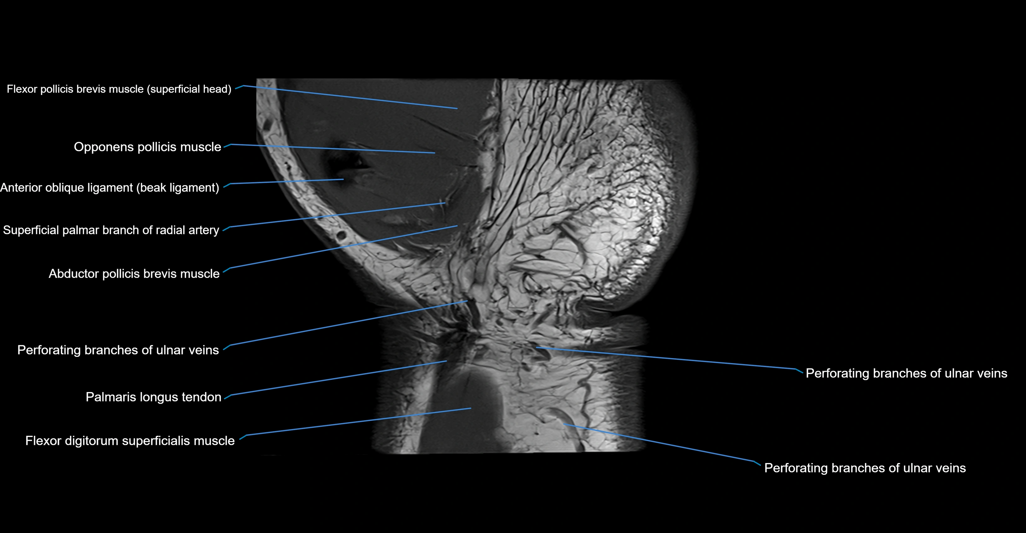 MRI wrist coronal cross sectional anatomy 3T  radiology  image-img-00001-00024.webp